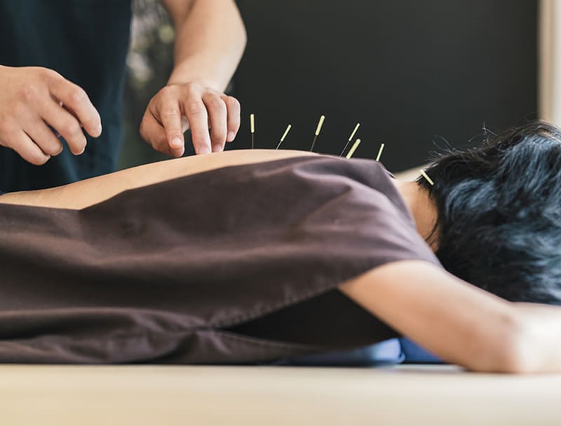 Acupuncture