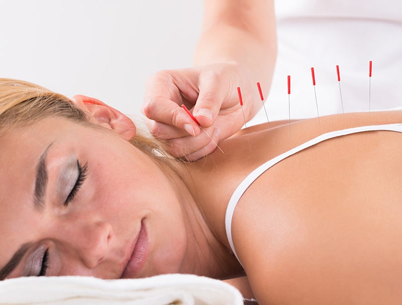 Acupuncture Therapy in Calgary