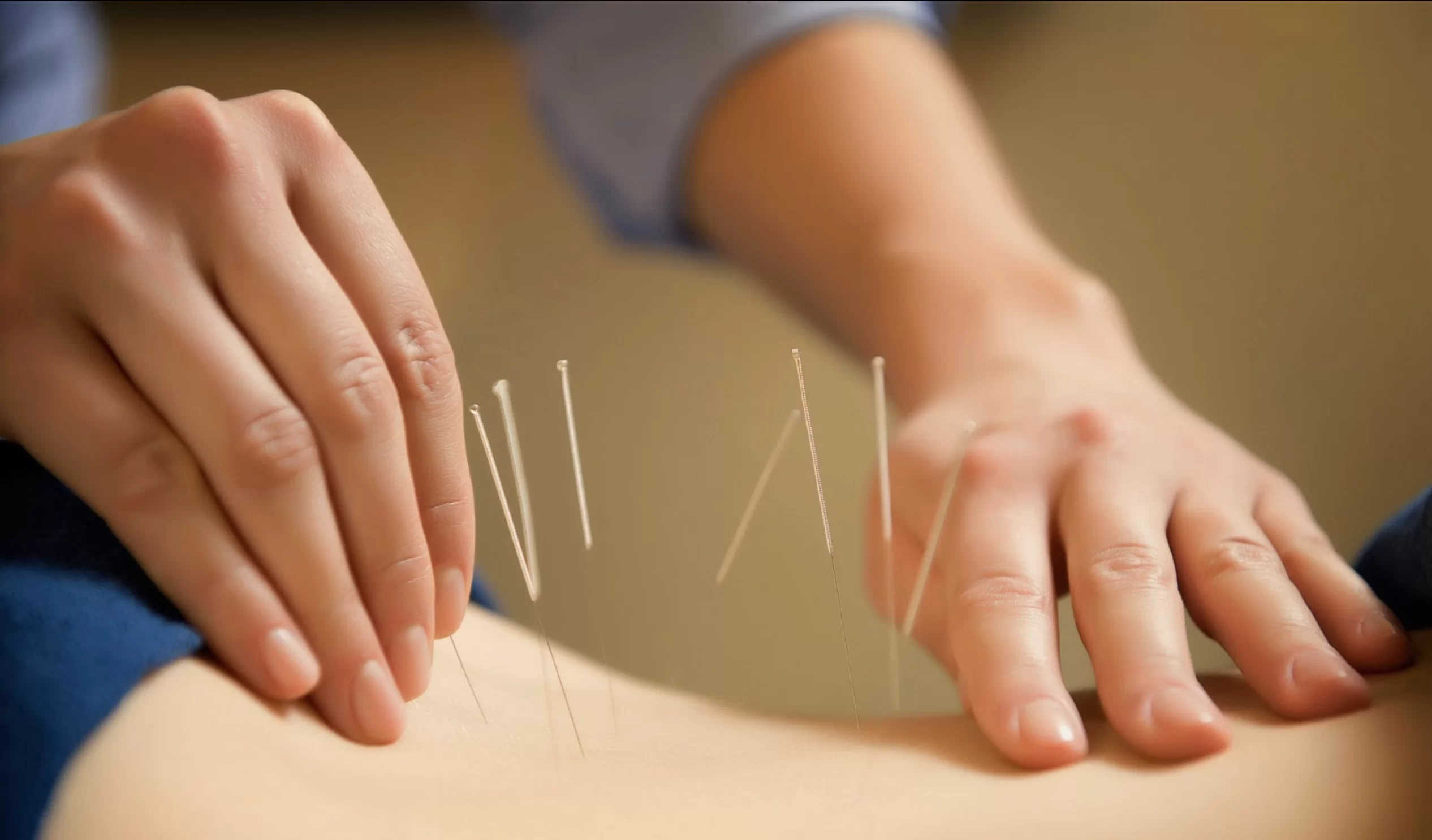 5-ways-acupuncture-can-promote-your-overall-health