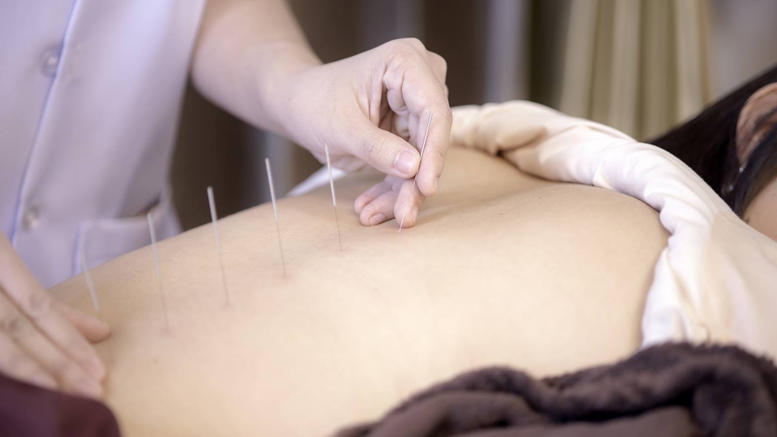 how-to-look-after-yourself-after-acupuncture