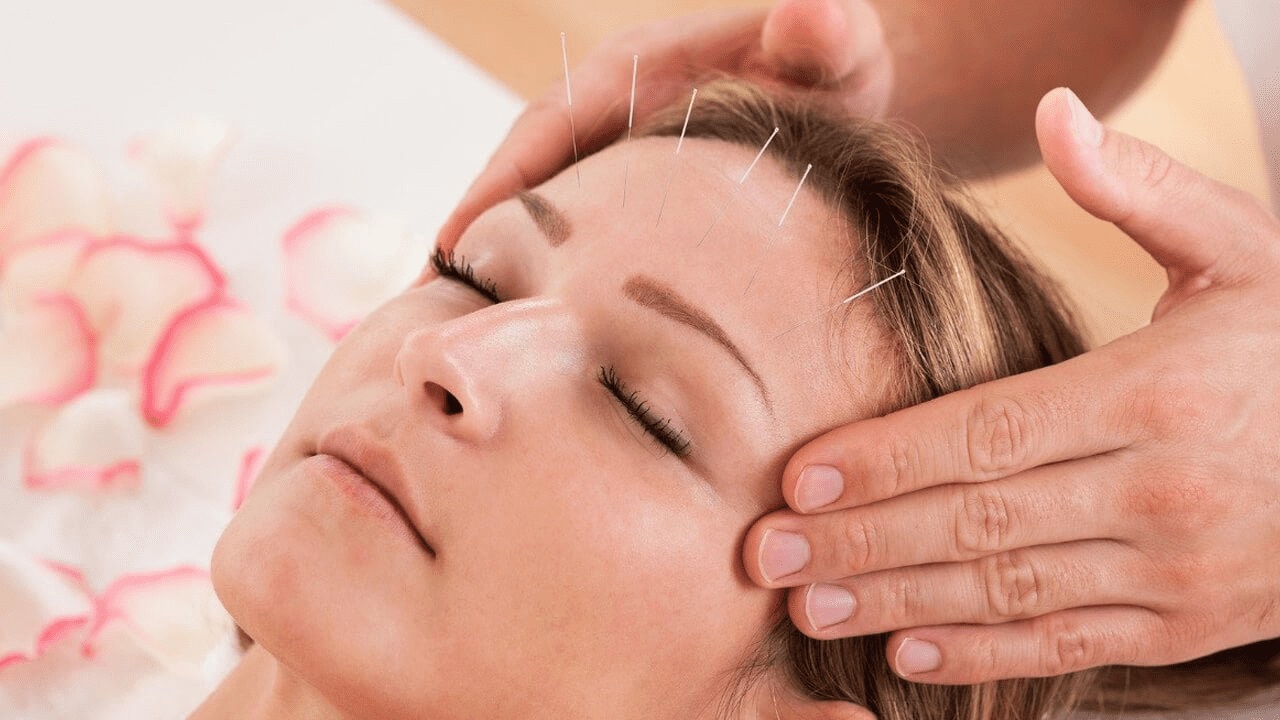 Benefits of Acupuncture For Headaches