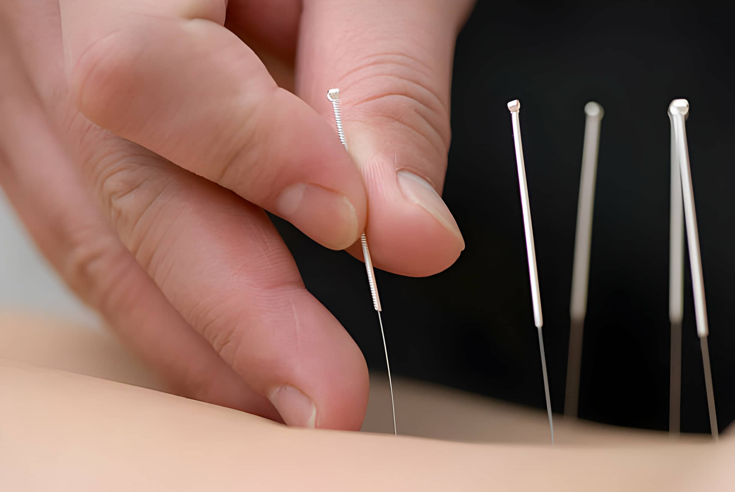 What should I expect after acupuncture?